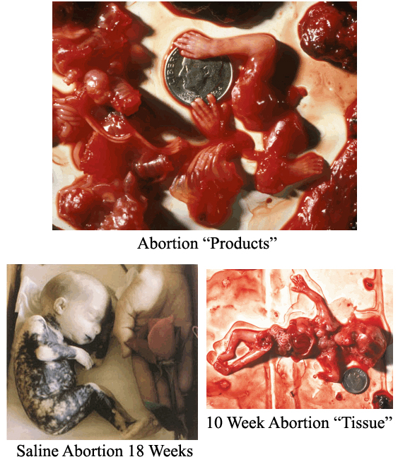 Aborted Babies